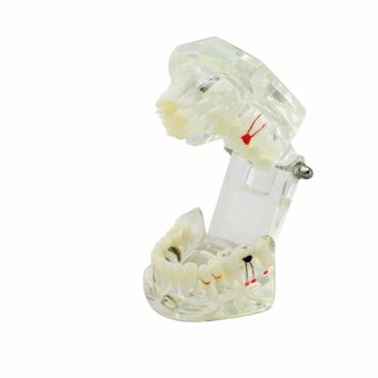 Dental Implant Disease Teeth Model with Restoration & Bridge Tooth - intl