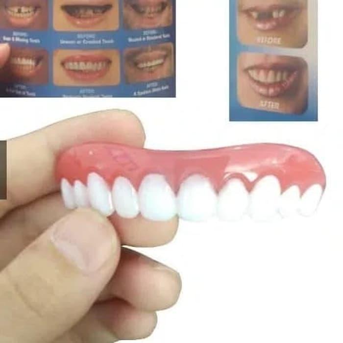 BEST SELLER Gigi Palsu Veneer Gigi Ompong Tambal Teeth Estetika Kecantikan Mulut - armFzmrA