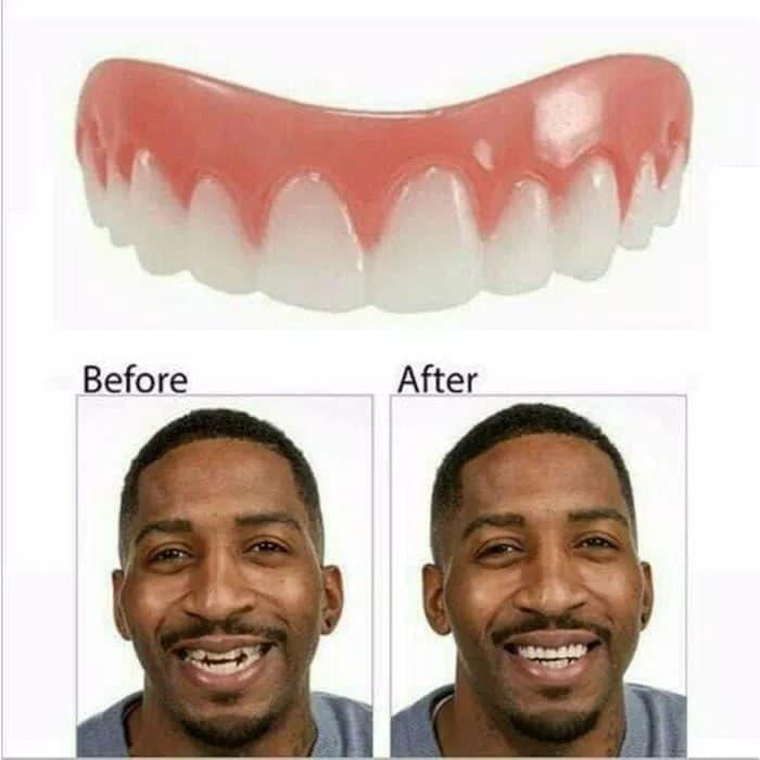 Promo Terbatas Gigi Palsu Veneer Gigi Ompong Tambal Teeth Estetika Kecantikan Mulut