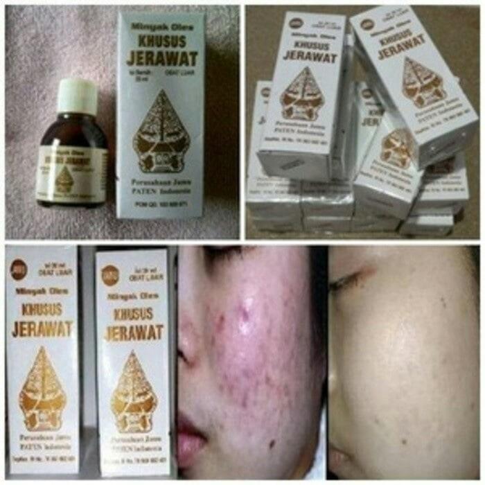 Minyak Oles Cap Wayang - Wayang Minyak Oles Khusus Jerawat Ampuh Anti Acne - Obat Herbal Alami Tradisional Obati Jerawat Bisul Wajah Bernanah Kulit Halus Segar Berseri - Produk Perwatan Kulit Face Skin Beauty - Obat Jerawat Ampuh - Obat Jerawat Cap Wayang