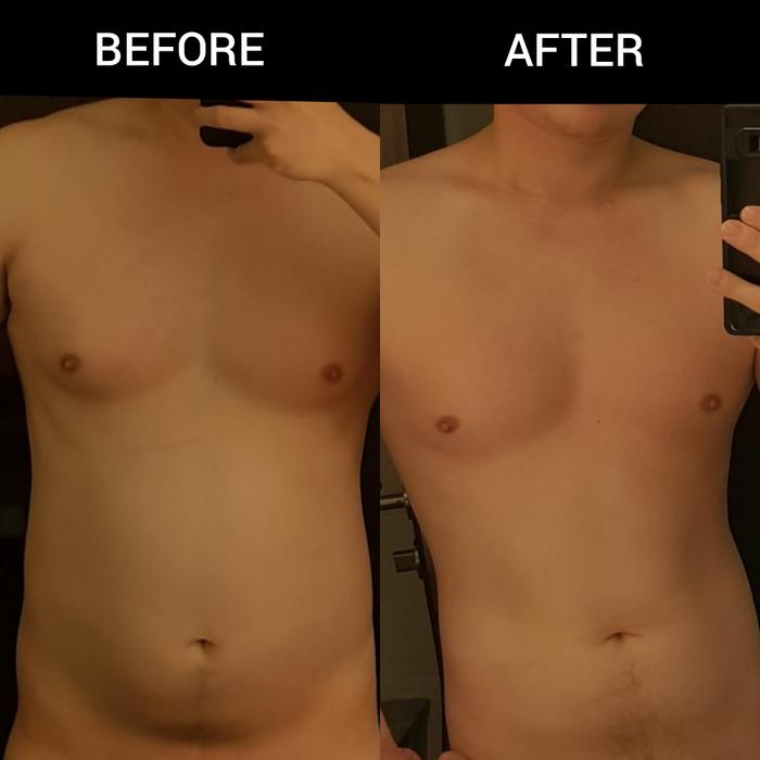 Super Promo! Aqualyx Liposuction - Suntik Penghancur Lemak Pelangsing Bakar Lemak