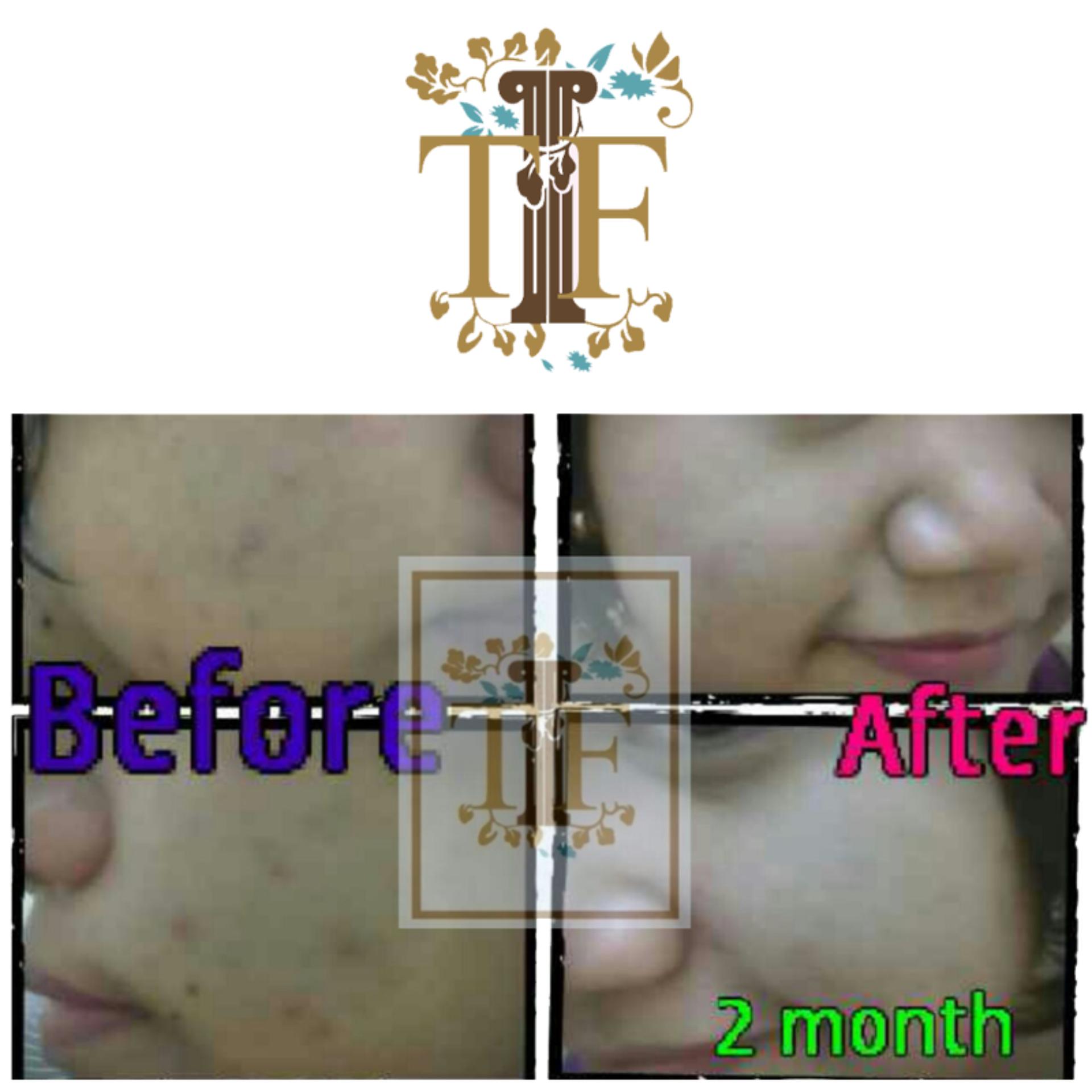 TLF Beauty Water Obat Penghilang Bekas Jerawat dan Flek Hitam