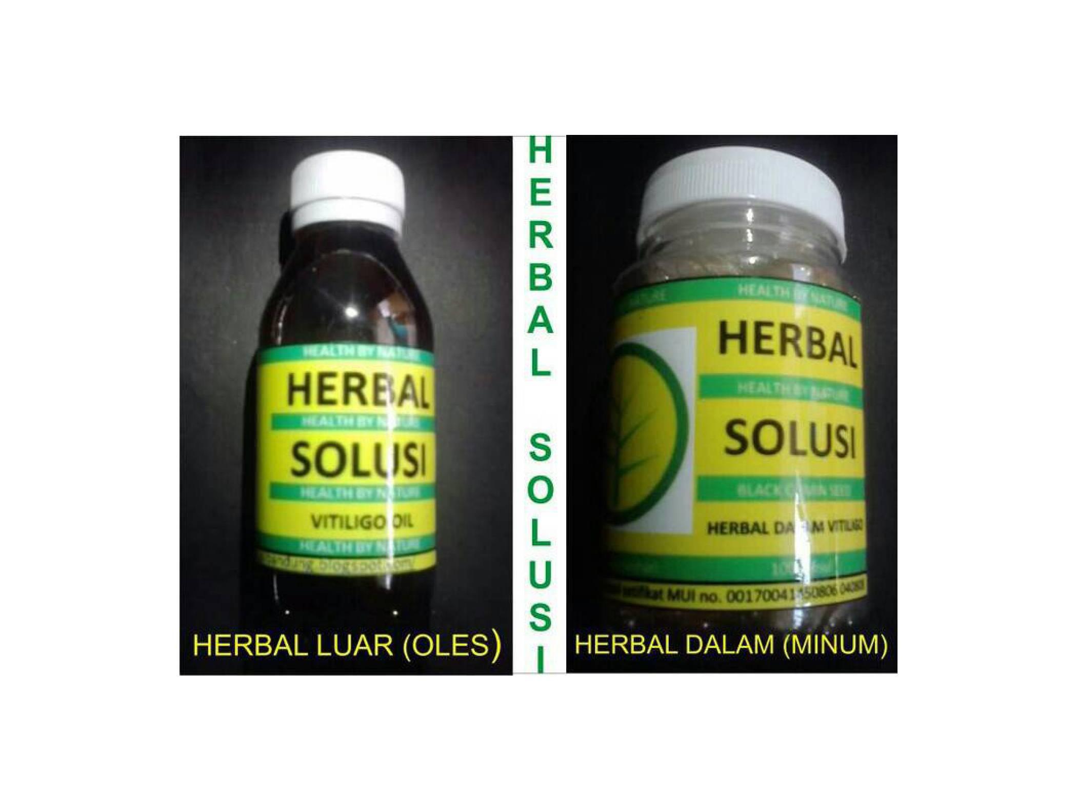 paket obat herbal vitiligo (vitiligo oil + herbal dalam)