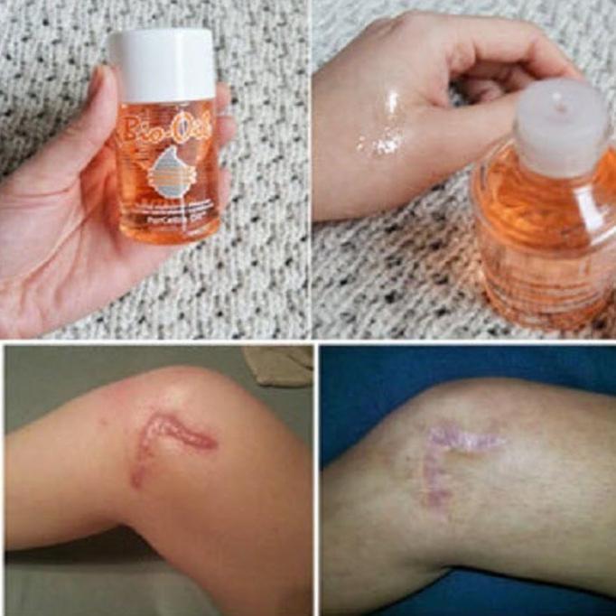 BIO OIL PENGHILANG LUKA DAN STREACHMARK 125 ML - COSME18