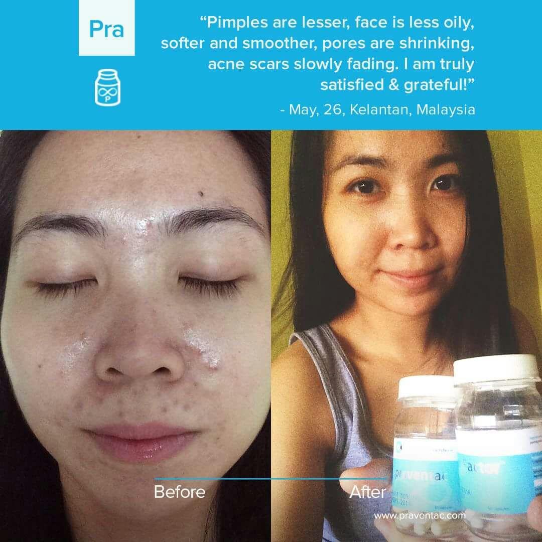 PRAVENTAC suplemen jerawat dan bekas jerawat hilang dalam 1 bulan tanpa bekas acne care