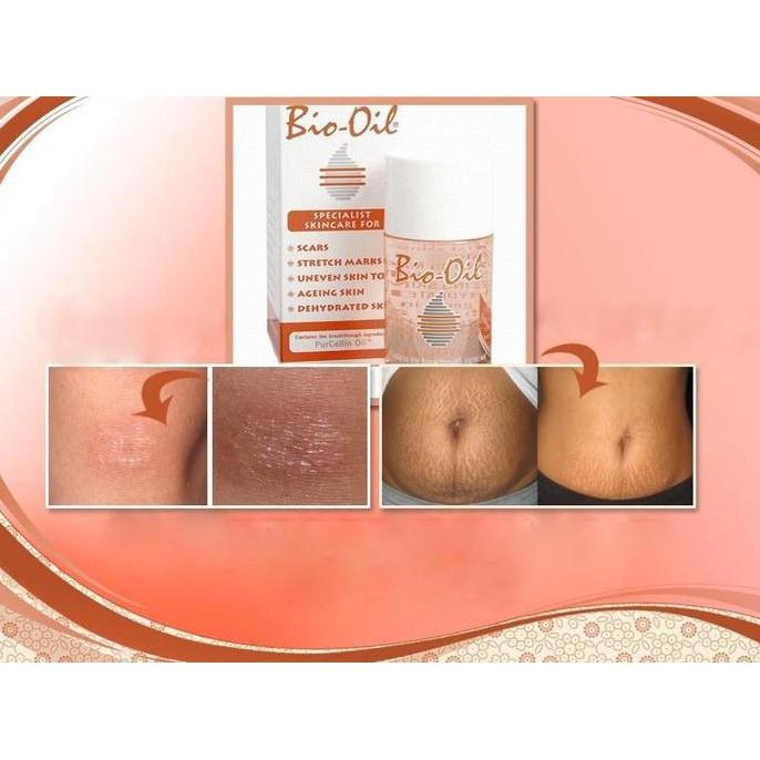 BIO OIL PENGHILANG LUKA DAN STREACHMARK - COSME18