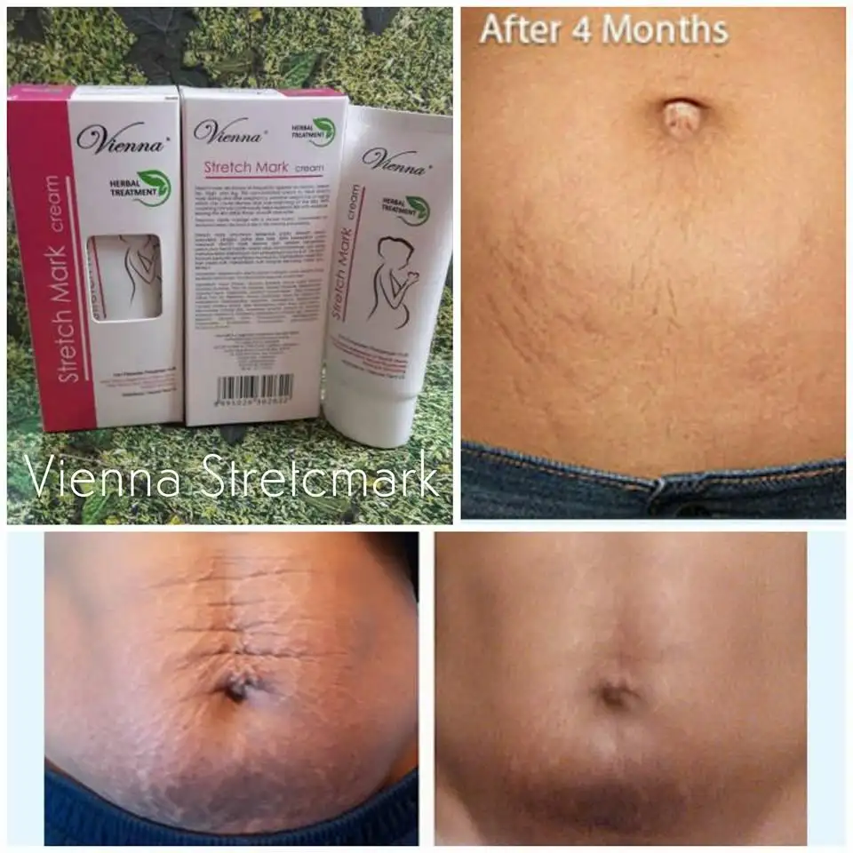 Vienna Stretch Mark Cream Bpom Krim Penghilang Stretch Mark Penghilang Stretchmark Krim Penghilang Stretchmark Selulit Dan Kerutan Pada Paha Atau Perut Setelah Melahirkan Lazada Indonesia