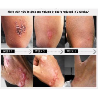 Elicina Plus Snail Cream 40g - Penghilang Jerawat Bekas Luka Anti Aging Flek Anti Jerawat September 2019 - 4 Elicina Plus Snail Cream 40g - Penghilang Jerawat Bekas Luka Anti Aging Flek Anti Jerawat - 4