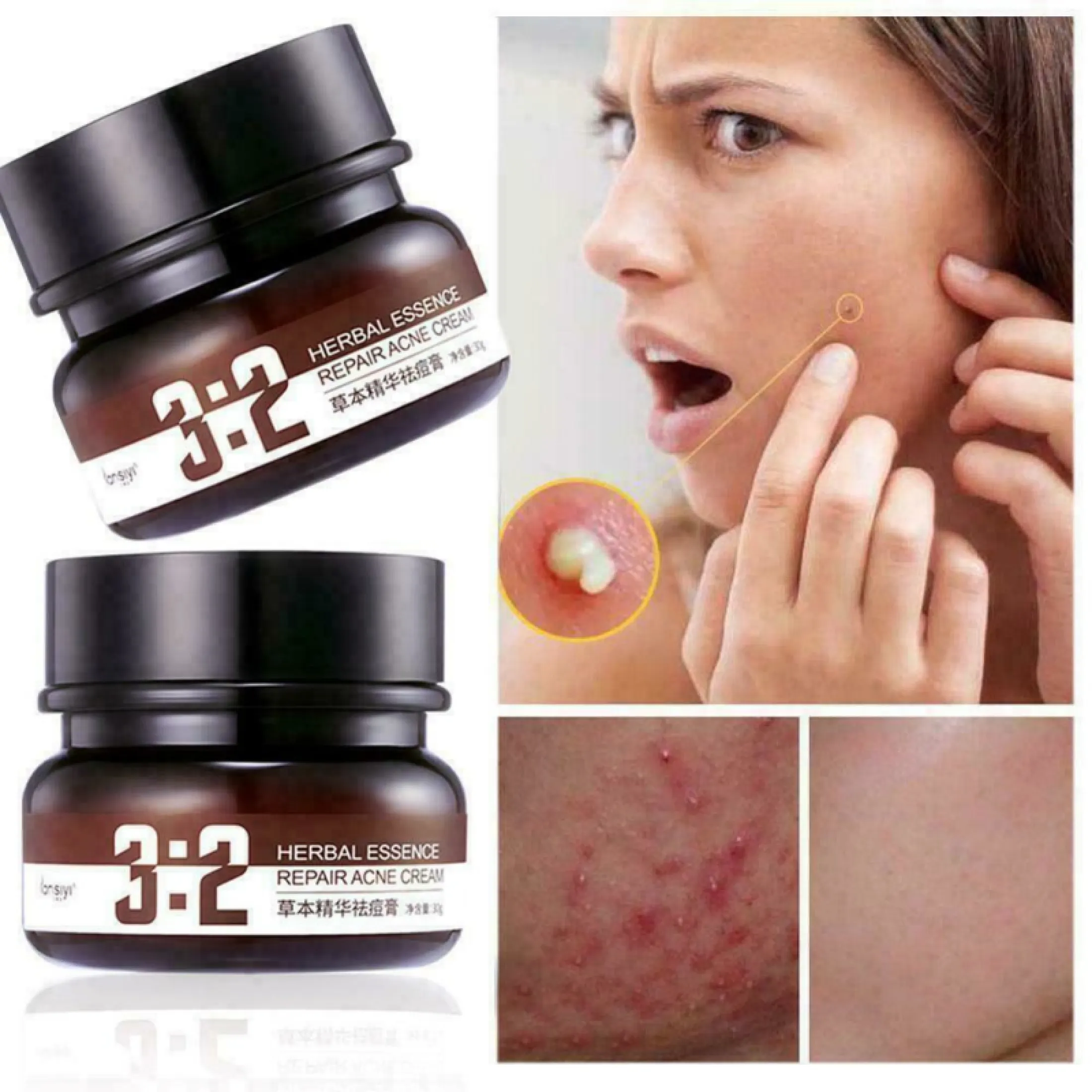 blackhead remover cream