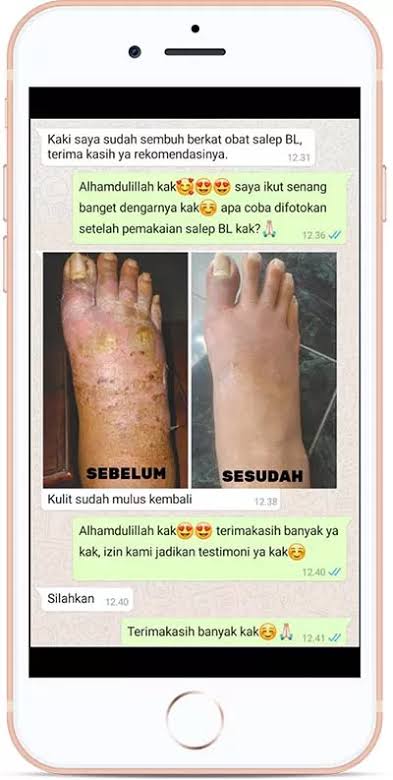 Salep Bl Salep Bl Ori Salep Bl China Salep Gatal Bl Salep Gatal Selangkangan Bl Salep Gatal Kulit Bl Salep Bl Gatal Salep Kurap Salep Bl Kurap Salep Bl Eksim Salep Bl Exim Salep Bl Salep Bl Ori Salep Bl China Salep Gatal Bl Salep Gatal Selangkangan Bl Salep Gatal Kulit Bl Salep Bl Gatal Salep Kurap Salep Bl Kurap Salep Bl Eksim Salep Bl Exim