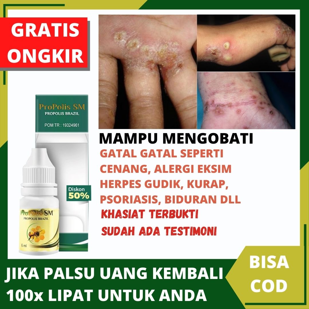 Jual Obat Nanah Telapak Kaki Terbaru Lazada Co Id