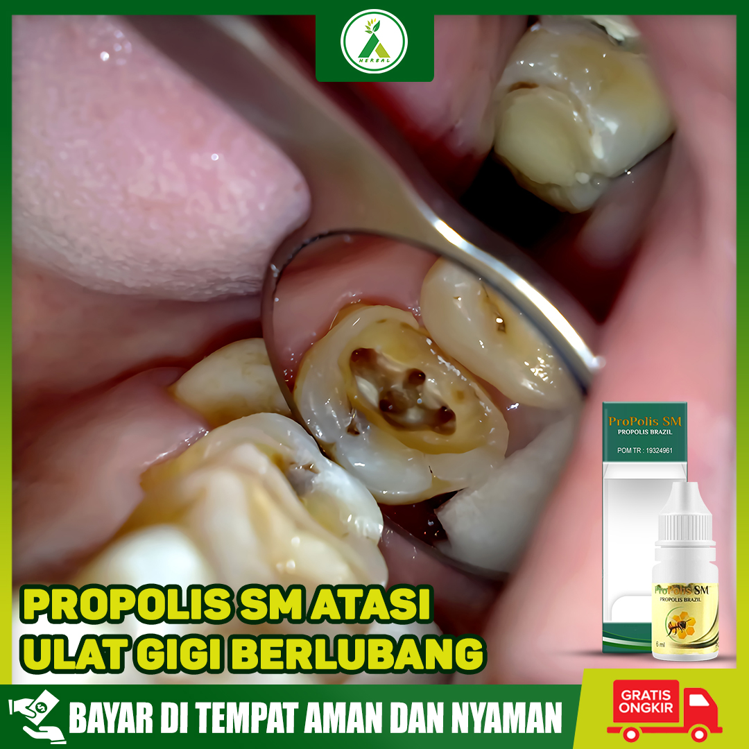Obat Untuk Mengeluarkan Ulat Gigi Obat Herbal Pembasmi Ulat Gigi Anak Dan Dewasa Atasi Dengan Propolis Sm Asli 100 Original Lazada Indonesia