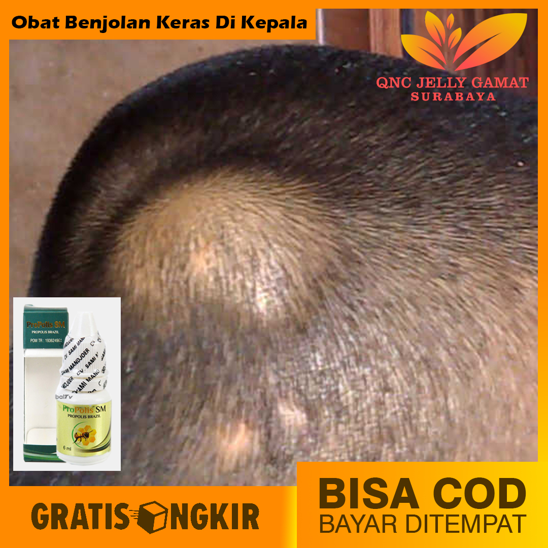 Obat Benjolan Keras Di Kepala Di Leher Di Jidat Di Belangkang Telinga Benjolan Di Kemaluan Propolis Sm Lazada Indonesia