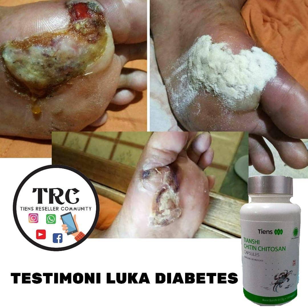 luka diabetes mellitus luka diabetes mellitus